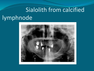 Sialolith from calcified
lymphnode
 
