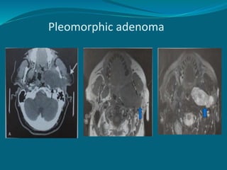Pleomorphic adenoma
 