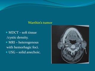 Warthin’s tumor
 MDCT – soft tissue
/cystic density.
 MRI – heterogenous
with hemorhagic foci.
 USG – solid anechoic.
 
