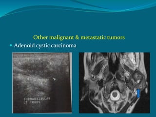 Other malignant & metastatic tumors
 Adenoid cystic carcinoma
 