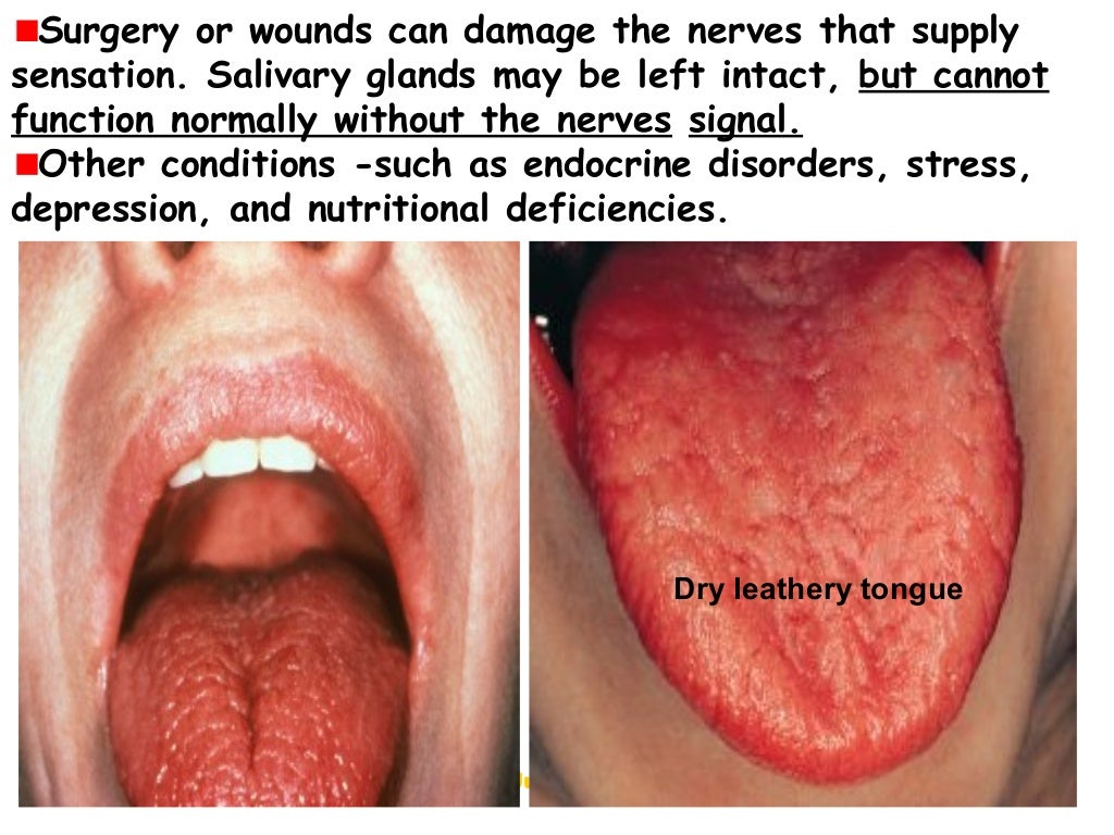 Salivary gland infections