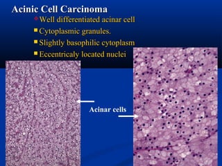 Salivary gland pathology | PPT