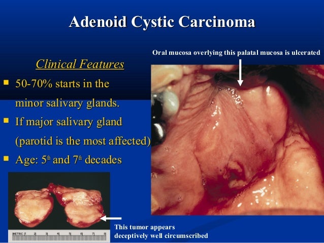 Salivary gland pathology