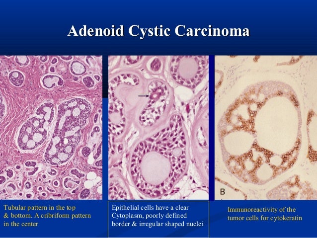 Salivary gland pathology
