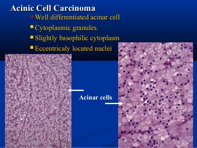 salivary gland pathology carcinoma acinic acinar cystic cytoplasmic necrosis adenoid