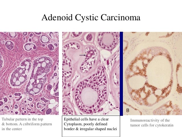 Salivary gland pathoology 1 epidermoid cyst diagram 