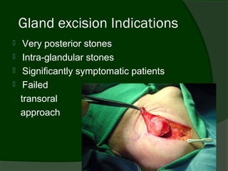 Gland excision Indications
    Very posterior stones
    Intra-glandular stones
    Significantly symptomatic patients
    Failed
    transoral
    approach
 