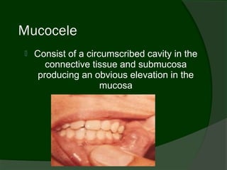 Mucocele
   Consist of a circumscribed cavity in the
       connective tissue and submucosa
     producing an obvious elevation in the
                     mucosa
 
