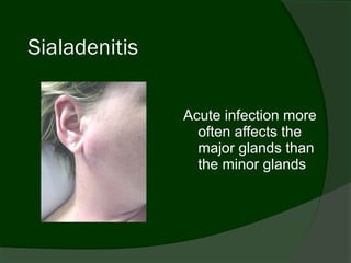 Sialadenitis

               Acute infection more
                 often affects the
                 major glands than
                 the minor glands
 