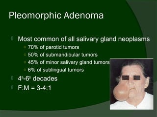 Pleomorphic Adenoma

   Most common of all salivary gland neoplasms
      ○ 70% of parotid tumors
      ○ 50% of submandibular tumors
      ○ 45% of minor salivary gland tumors
      ○ 6% of sublingual tumors
   4th-6th decades
   F:M = 3-4:1
 