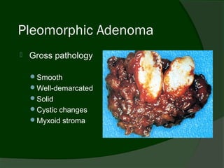 Pleomorphic Adenoma
   Gross pathology

    Smooth
    Well-demarcated
    Solid
    Cystic changes
    Myxoid stroma
 