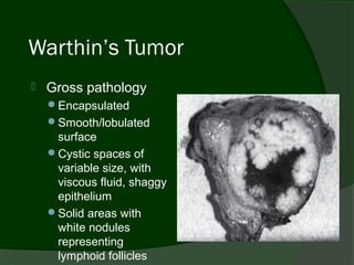 Warthin’s Tumor
   Gross pathology
    Encapsulated
    Smooth/lobulated
     surface
    Cystic spaces of
     variable size, with
     viscous fluid, shaggy
     epithelium
    Solid areas with
     white nodules
     representing
     lymphoid follicles
 