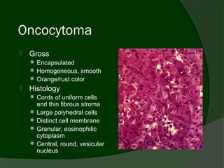 Oncocytoma
   Gross
     Encapsulated
     Homogeneous, smooth
     Orange/rust color
   Histology
     Cords of uniform cells
      and thin fibrous stroma
     Large polyhedral cells
     Distinct cell membrane
     Granular, eosinophilic
      cytoplasm
     Central, round, vesicular
      nucleus
 