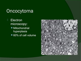 Oncocytoma
   Electron
    microscopy:
    Mitochondrial
     hyperplasia
    60% of cell volume
 