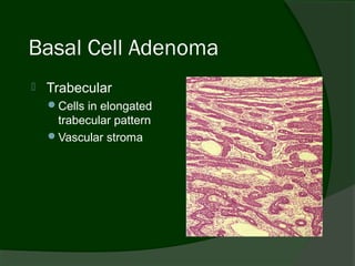 Basal Cell Adenoma
   Trabecular
    Cells in elongated
     trabecular pattern
    Vascular stroma
 