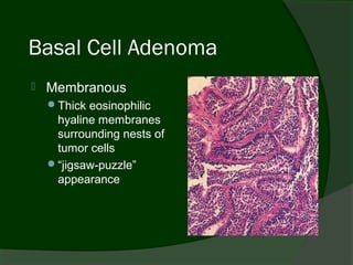 Basal Cell Adenoma
   Membranous
    Thick eosinophilic
     hyaline membranes
     surrounding nests of
     tumor cells
    “jigsaw-puzzle”
     appearance
 