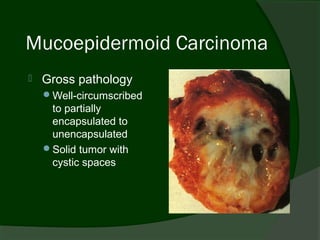 Mucoepidermoid Carcinoma
   Gross pathology
    Well-circumscribed
     to partially
     encapsulated to
     unencapsulated
    Solid tumor with
     cystic spaces
 