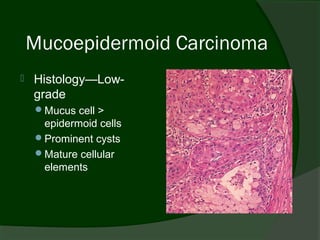 Mucoepidermoid Carcinoma
   Histology—Low-
    grade
    Mucus cell >
     epidermoid cells
    Prominent cysts
    Mature cellular
     elements
 