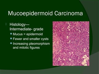 Mucoepidermoid Carcinoma
   Histology—
    Intermediate- grade
    Mucus = epidermoid
    Fewer and smaller cysts
    Increasing pleomorphism
     and mitotic figures
 