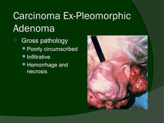 Carcinoma Ex-Pleomorphic
Adenoma
   Gross pathology
    Poorly circumscribed
    Infiltrative
    Hemorrhage and
     necrosis
 