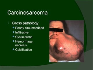 Carcinosarcoma
   Gross pathology
    Poorly circumscribed
    Infiltrative
    Cystic areas
    Hemorrhage,
     necrosis
    Calcification
 
