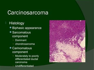 Carcinosarcoma
   Histology
    Biphasic appearance
    Sarcomatous
     component
      ○ Dominant
      ○ chondrosarcoma
    Carinomatous
     component
      ○ Moderately to poorly
        differentiated ductal
        carcinoma
      ○ Undifferentiated
 