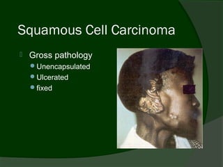 Squamous Cell Carcinoma
   Gross pathology
    Unencapsulated
    Ulcerated
    fixed
 