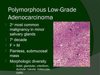 Polymorphous Low-Grade
    Adenocarcinoma
   2nd most common
    malignancy in minor
    salivary glands
   7th decade
   F>M
   Painless, submucosal
    mass
   Morphologic diversity
      ○ Solid, glandular, cribriform,
        ductular, tubular, trabecular,
        cystic
 
