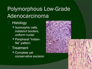 Polymorphous Low-Grade
Adenocarcinoma
   Histology
    Isomorphic cells,
     indistinct borders,
     uniform nuclei
    Peripheral “Indian-
     file” pattern
   Treatment
    Complete yet
     conservative excision
 