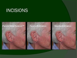INCISIONS
 