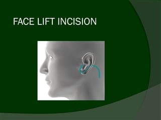 FACE LIFT INCISION
 