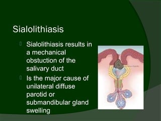 Sialolithiasis
    Sialolithiasis results in
     a mechanical
     obstuction of the
     salivary duct
    Is the major cause of
     unilateral diffuse
     parotid or
     submandibular gland
     swelling
 