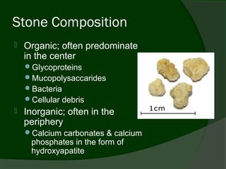 Stone Composition
   Organic; often predominate
    in the center
    Glycoproteins
    Mucopolysaccarides
    Bacteria
    Cellular debris
   Inorganic; often in the
    periphery
    Calcium carbonates & calcium
     phosphates in the form of
     hydroxyapatite
 