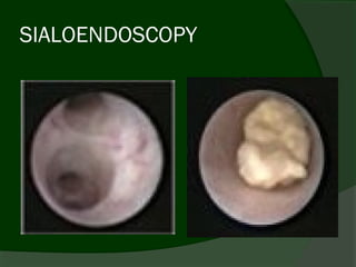 SIALOENDOSCOPY
 
