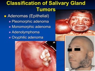 Classification of Salivary Gland
Tumors
n 

Adenomas (Epithelial)
n  Pleomorphic

adenoma
n  Monomorphic adenoma
n  Adenolymphoma
n  Oxyphilic adenoma

 