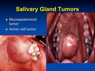Salivary Gland Tumors
n 

n 

Mucoepidermoid
tumor
Acinic cell tumor

 