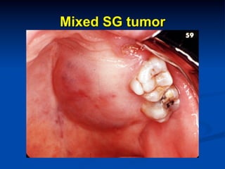 Mixed SG tumor

 