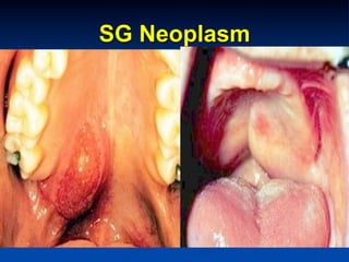 SG Neoplasm

 
