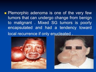 n 

Plemorphic adenoma is one of the very few
tumors that can undergo change from benign
to malignant . Mixed SG tumors is poorly
encapsulated and had a tendency toward
local recurrence if only enucleated .

 