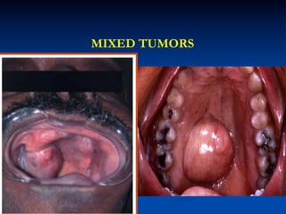 MIXED TUMORS

 