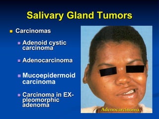 Salivary Gland Tumors
n 

Carcinomas
n  Adenoid

cystic
carcinoma

n  Adenocarcinoma

n  Mucoepidermoid

carcinoma

n  Carcinoma

in EXpleomorphic
adenoma

Adenocarcinoma

 