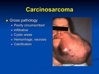 Carcinosarcoma
n 

Gross pathology
n 
n 
n 
n 
n 

Poorly circumscribed
Infiltrative
Cystic areas
Hemorrhage, necrosis
Calcification

 