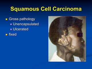 Squamous Cell Carcinoma
n 

n 

Gross pathology
n  Unencapsulated
n  Ulcerated
fixed

 
