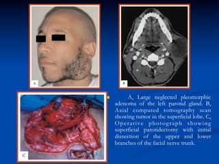 n 

A, Large neglected pleomorphic
adenoma of the left parotid gland. B,
Axial computed tomography scan
showing tumor in the superficial lobe. C,
Operative photograph showing
superficial parotidectomy with initial
dissection of the upper and lower
branches of the facial nerve trunk.

 