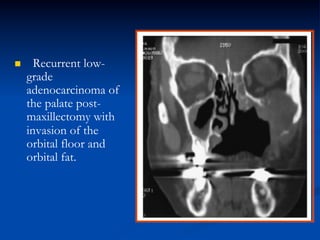 n 

Recurrent lowgrade
adenocarcinoma of
the palate postmaxillectomy with
invasion of the
orbital floor and
orbital fat.

 
