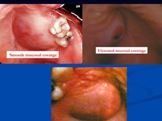 Smooth mucosal covarge

Ulcerated mucosal coverage

 