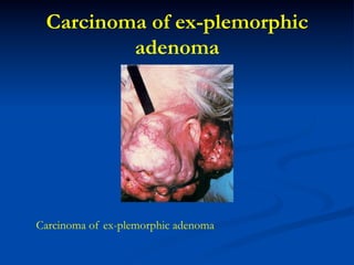Carcinoma of ex-plemorphic
adenoma

Carcinoma of ex-plemorphic adenoma

 