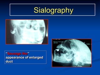 Sialography

“Sausage like”
appearance of enlarged
duct

 