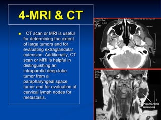 4-MRI & CT
n 

CT scan or MRI is useful
for determining the extent
of large tumors and for
evaluating extraglandular
extension. Additionally, CT
scan or MRI is helpful in
distinguishing an
intraparotid deep-lobe
tumor from a
parapharyngeal space
tumor and for evaluation of
cervical lymph nodes for
metastasis.

 