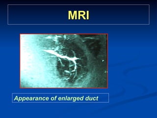 MRI

Appearance of enlarged duct

 